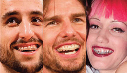 celebrities wearing braces