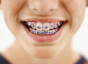 Do you have questions about braces?