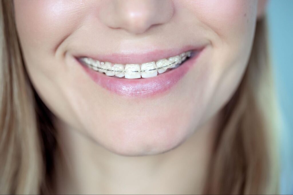What Orthodontic Treatment Is Best for Adults?