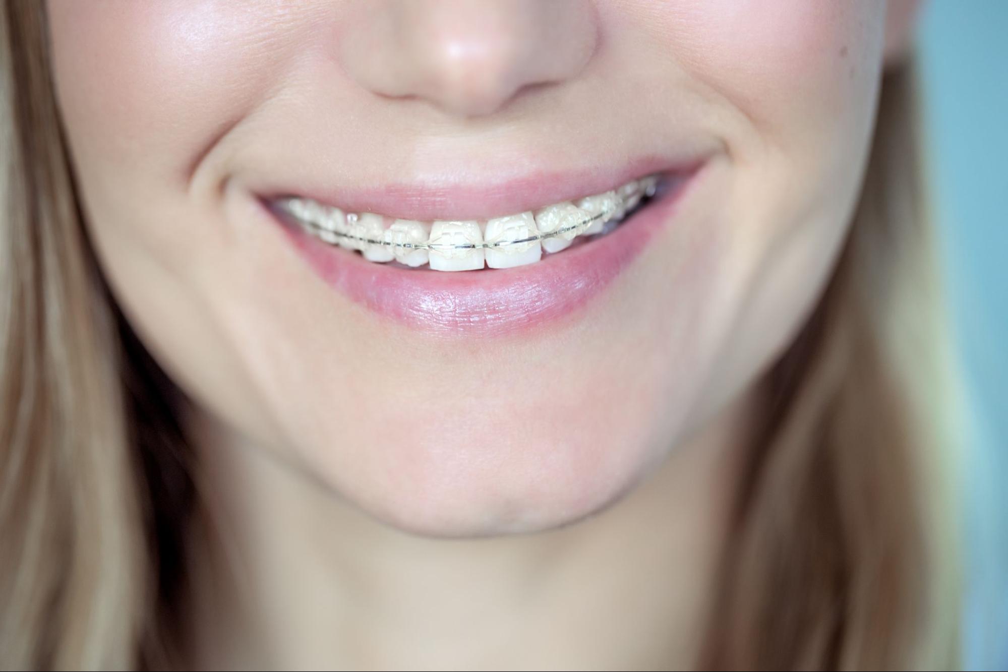 What Orthodontic Treatment Is Best for Adults?